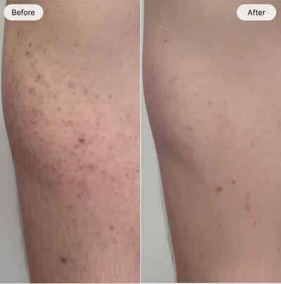 Acné and dryness gone